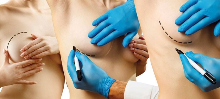 Augmentation mammaire Tunisie : prothèses mammaires ou lipofiling, Prix, cliniques et meilleurs chirurgiens Tunisiens